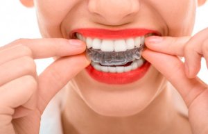 Invisalign – невидимая альтернатива брекетам