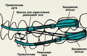 Роль аппаратов Энгля в ортодонтии