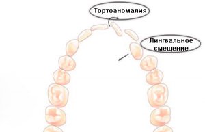 Аномалии положения отдельных зубов